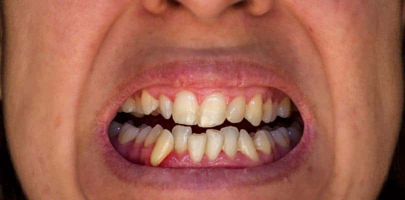 an image of crooked teeth