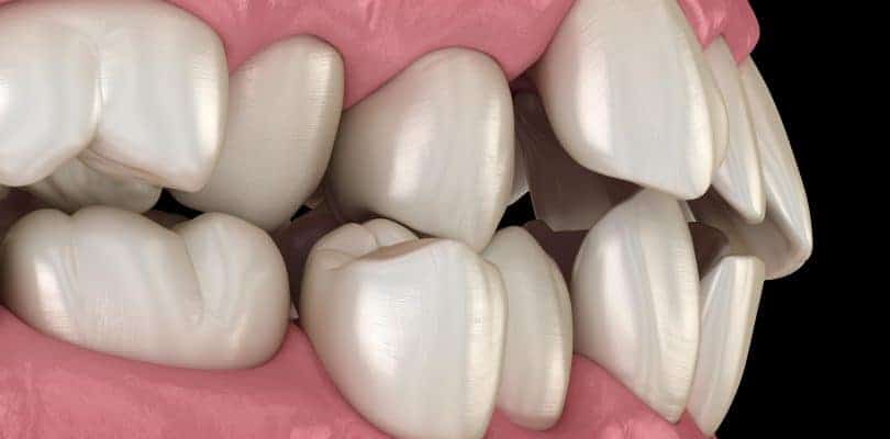 tooth misalignment