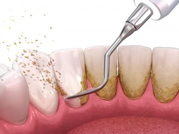 dental plaque