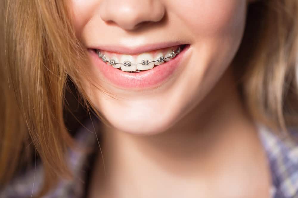 Transform your smile with the magic of dental braces.