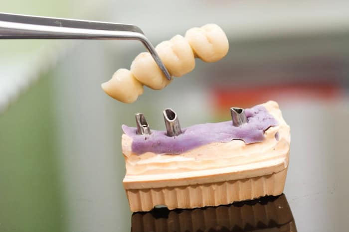 Dental Crowns